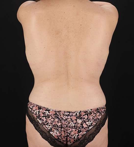 Abdominoplasty (Tummy Tuck) Before & After Patient #653