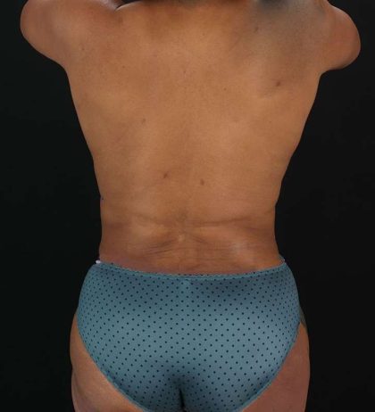 Abdominoplasty (Tummy Tuck) Before & After Patient #990