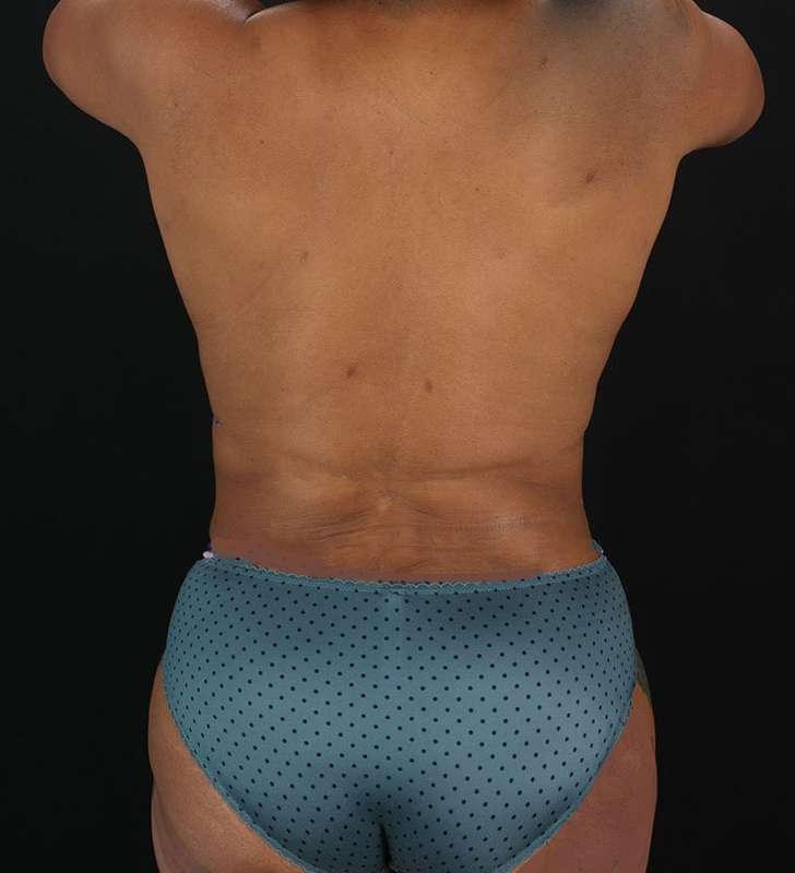 Abdominoplasty (Tummy Tuck) Before & After Patient #990