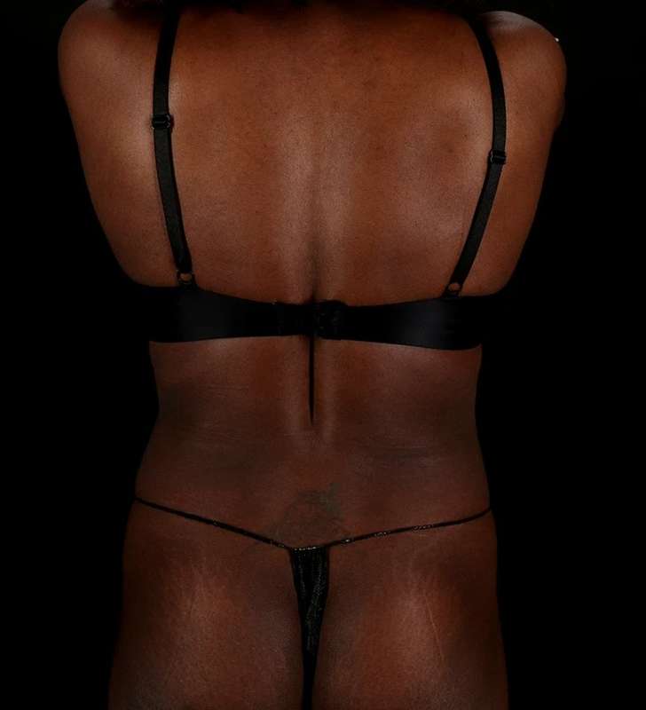 Abdominoplasty (Tummy Tuck) Before & After Patient #1045