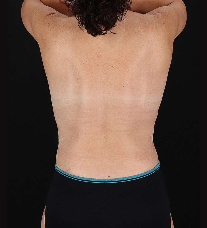 Abdominoplasty (Tummy Tuck) Before & After Patient #1058