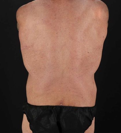 Cosmetic Body Lift Before & After Patient #1200