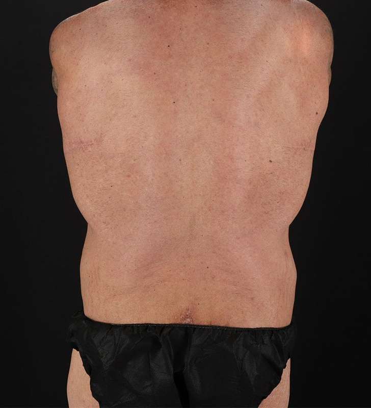 Cosmetic Body Lift Before & After Patient #1200