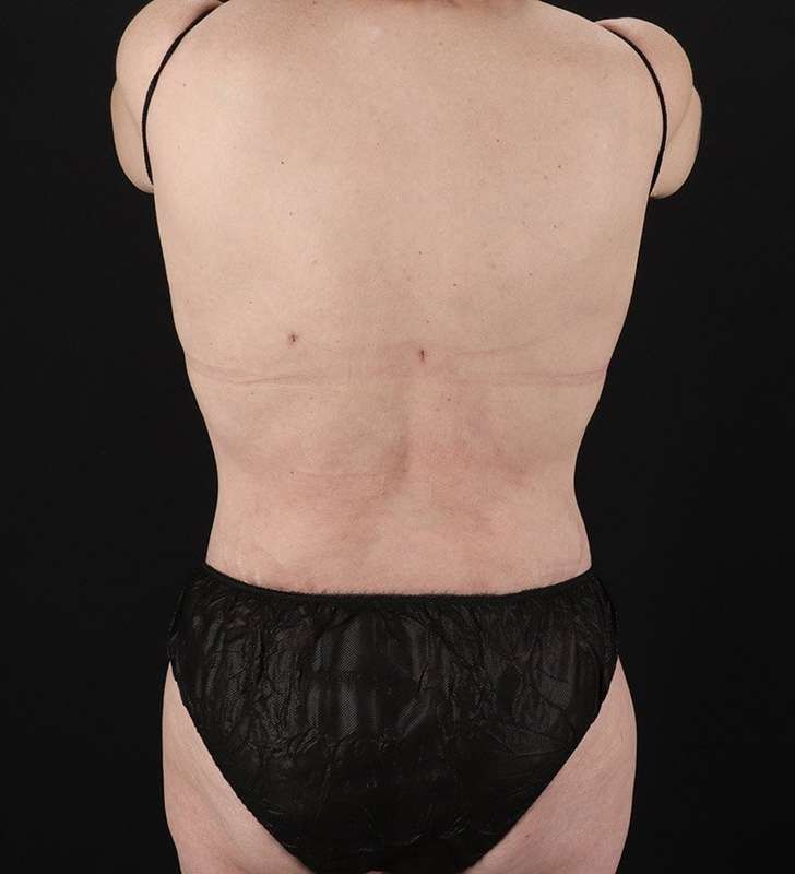 Cosmetic Body Lift Before & After Patient #1218