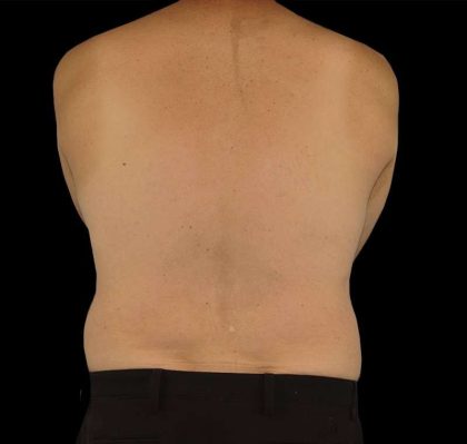 Liposuction Before & After Patient #1270