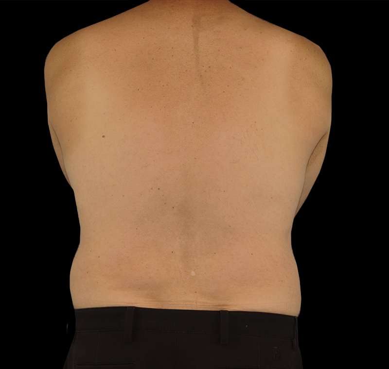 Liposuction Before & After Patient #1270