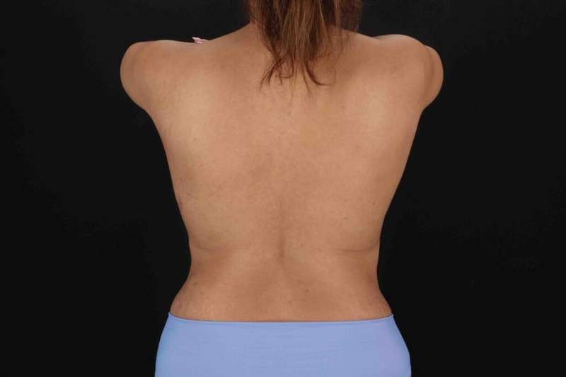 Liposuction Before & After Patient #1403