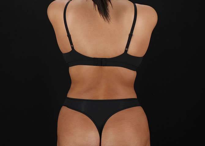 Liposuction Before & After Patient #1469