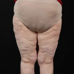 Liposuction Before & After Patient #1495