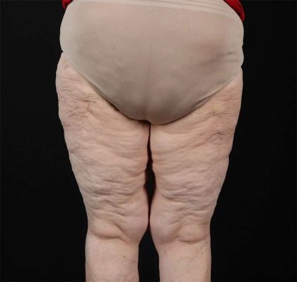 Liposuction Before & After Patient #1495