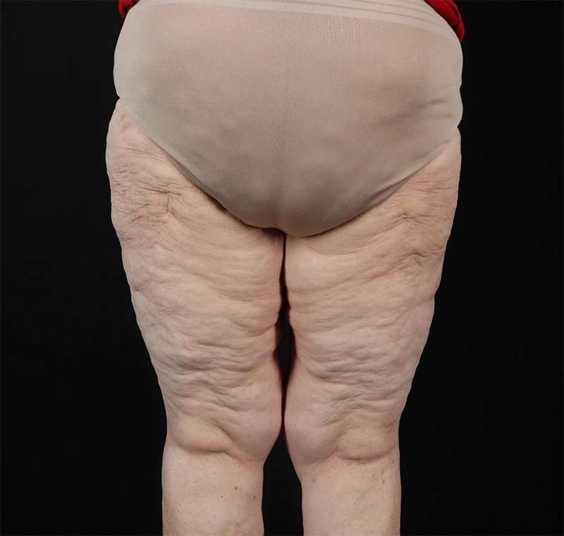 Liposuction Before & After Patient #1495