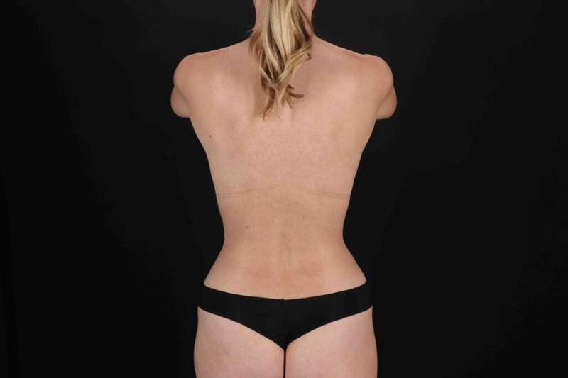 Abdominoplasty (Tummy Tuck) Before & After Patient #706