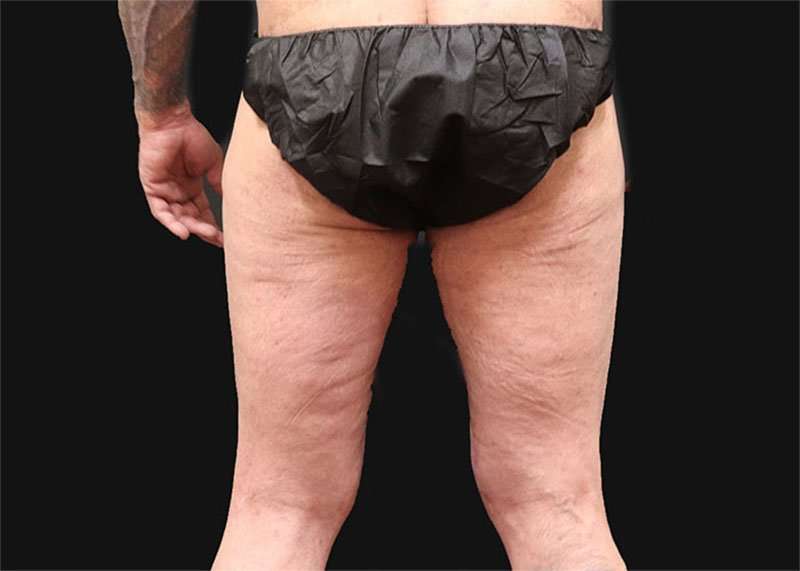 Thigh Lift Before & After Patient #1776