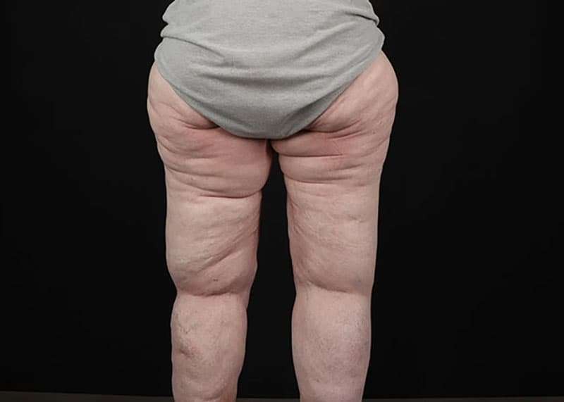 Thigh Lift Before & After Patient #1790