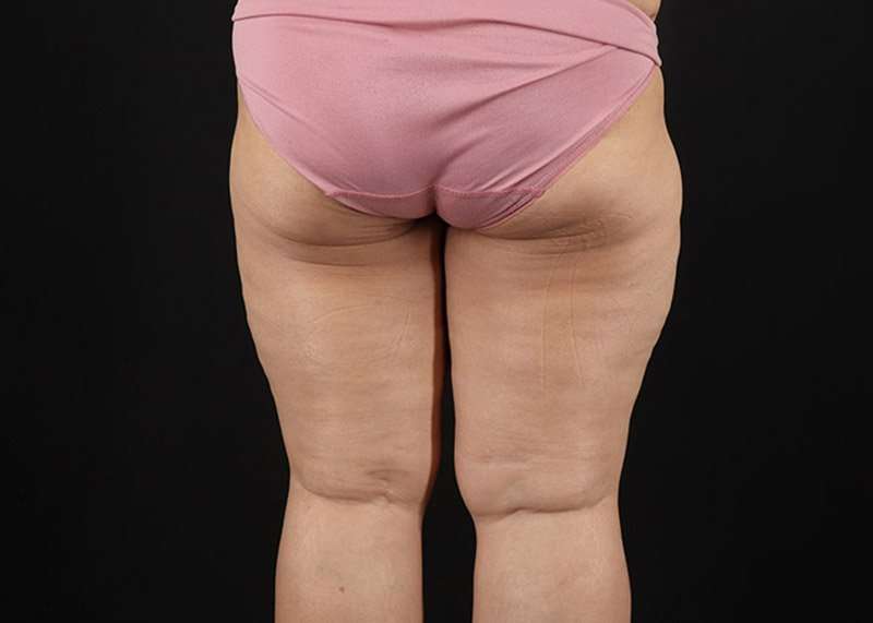 Thigh Lift Before & After Patient #1804