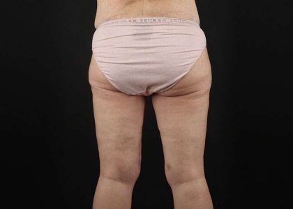 Thigh Lift Before & After Patient #1818