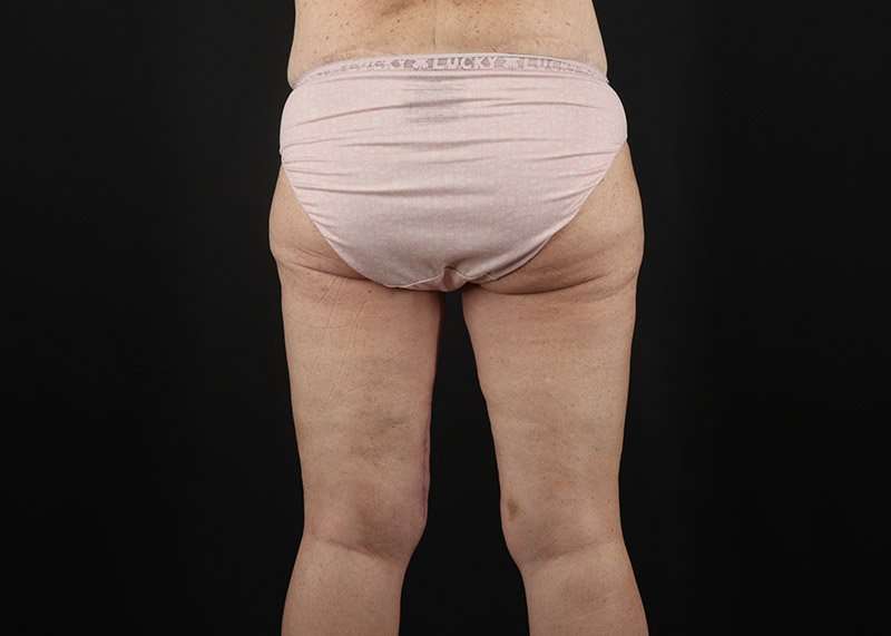 Thigh Lift Before & After Patient #1818