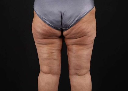 Thigh Lift Before & After Patient #1831
