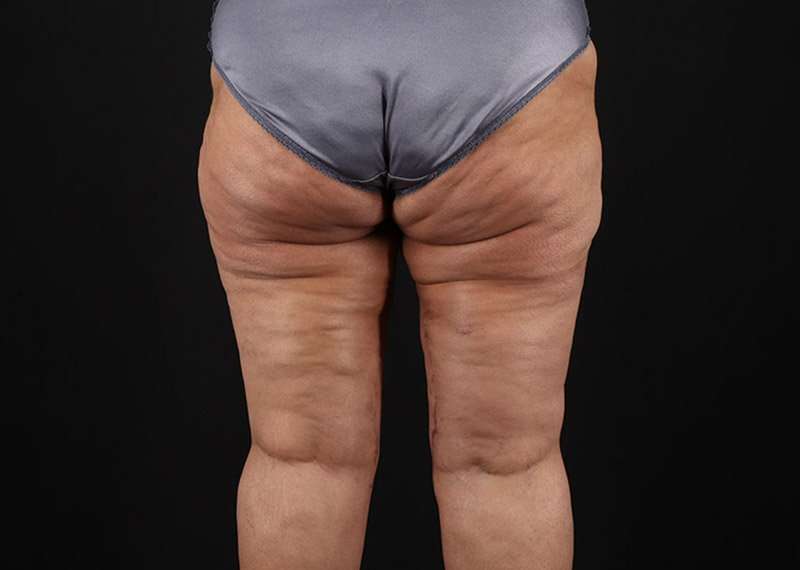 Thigh Lift Before & After Patient #1831