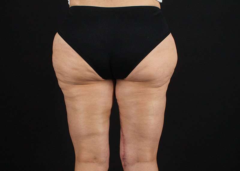 Thigh Lift Before & After Patient #1844