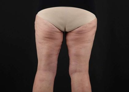 Thigh Lift Before & After Patient #1857