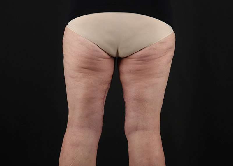 Thigh Lift Before & After Patient #1857