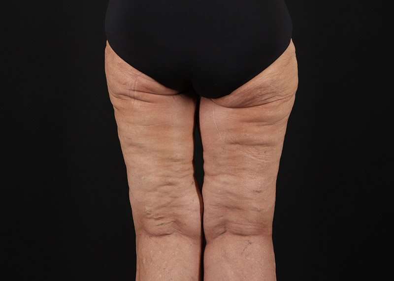 Thigh Lift Before & After Patient #1871