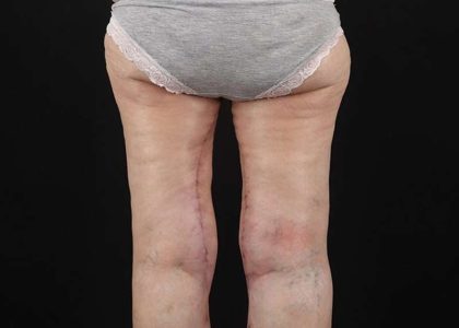 Thigh Lift Before & After Patient #1884