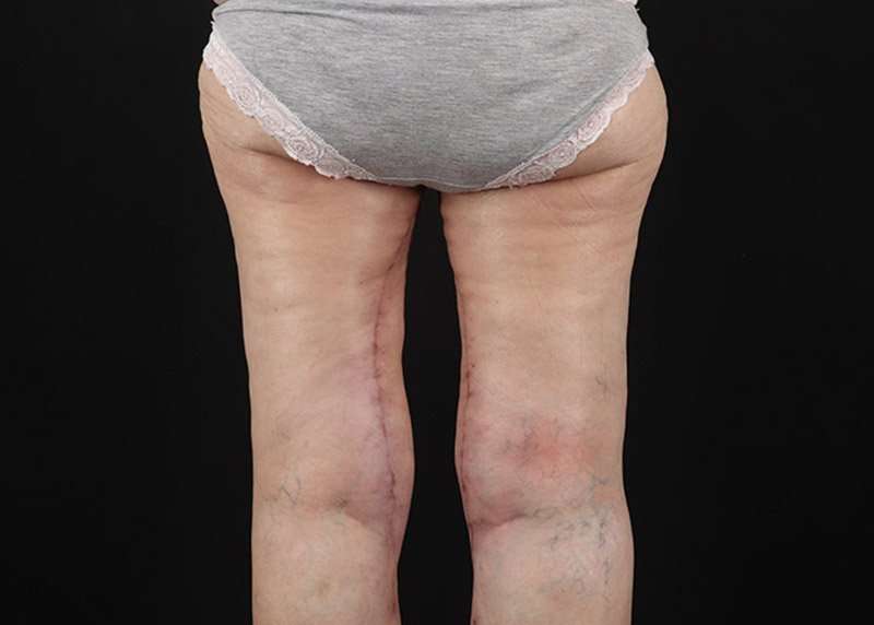 Thigh Lift Before & After Patient #1884