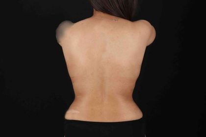 Abdominoplasty (Tummy Tuck) Before & After Patient #640