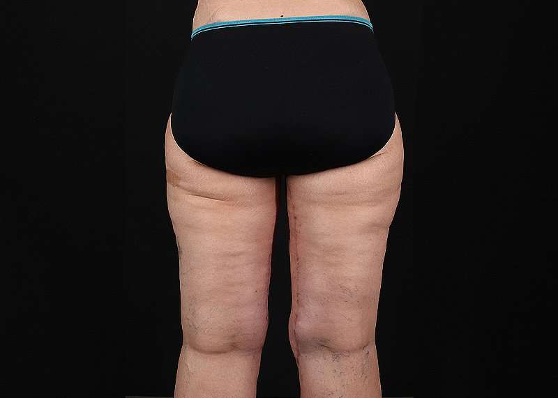Thigh Lift Before & After Patient #1897