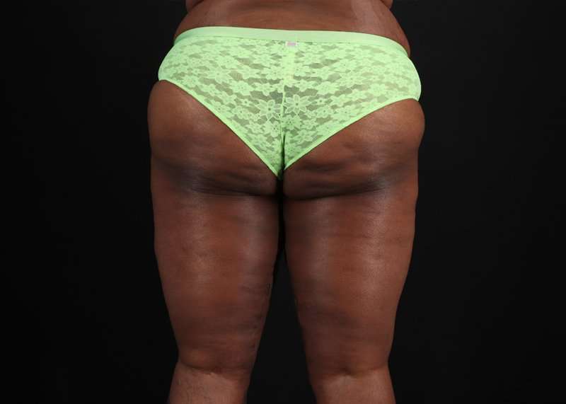Thigh Lift Before & After Patient #1911