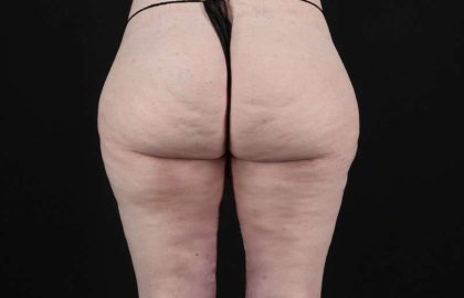 Thigh Lift Before & After Patient #1925