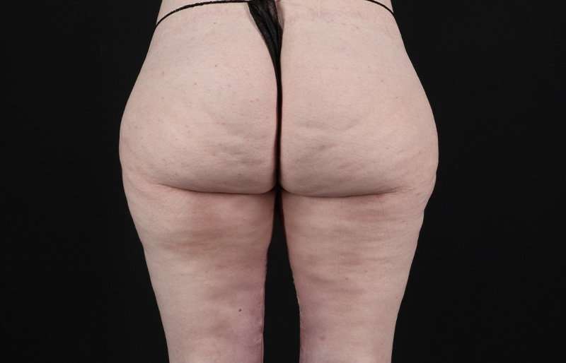 Thigh Lift Before & After Patient #1925