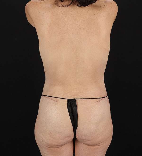 Breast Augmentation w/ Fat Transfer Before & After Patient #2088