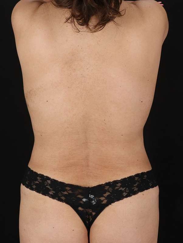 DIEP Flap Before & After Patient #3123