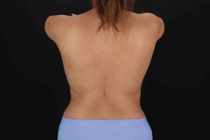 Abdominoplasty (Tummy Tuck) Before & After Patient #733
