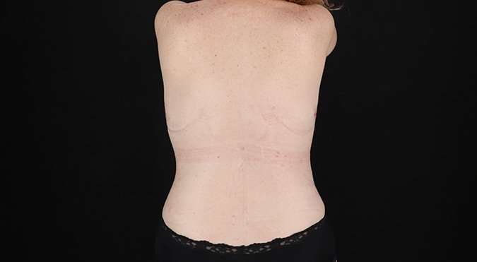 Mastopexy Before & After Patient #3178