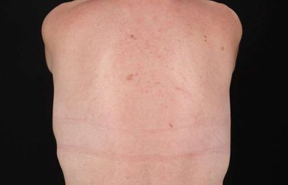 Breast Lift Before & After Patient #3809