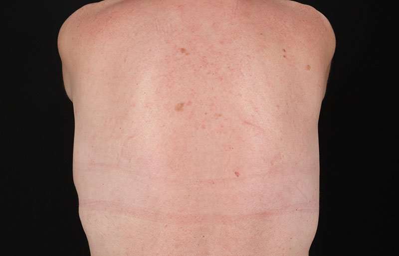 Breast Lift Before & After Patient #3809