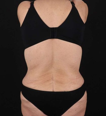 Abdominoplasty (Tummy Tuck) Before & After Patient #817