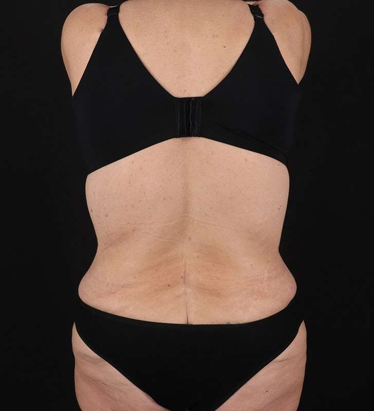 Abdominoplasty (Tummy Tuck) Before & After Patient #817