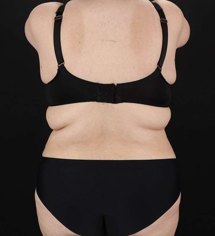 Abdominoplasty (Tummy Tuck) Before & After Patient #830