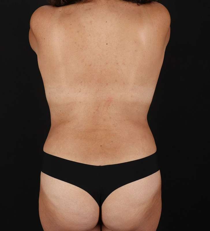 Abdominoplasty (Tummy Tuck) Before & After Patient #843