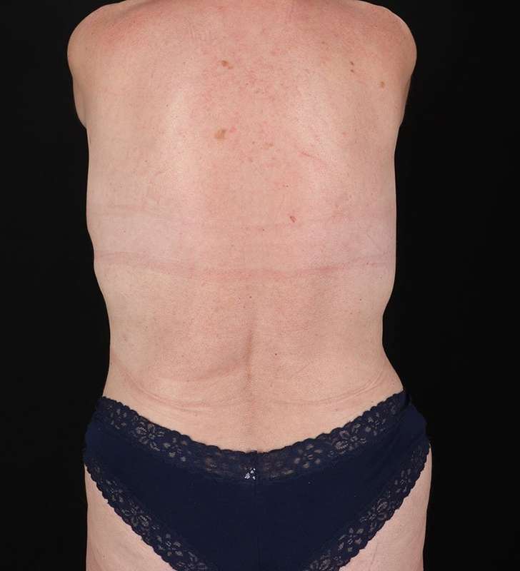 Abdominoplasty (Tummy Tuck) Before & After Patient #962