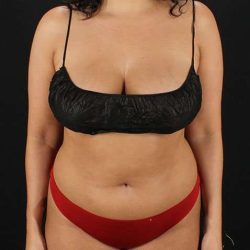 Liposuction Before & After Patient #1469