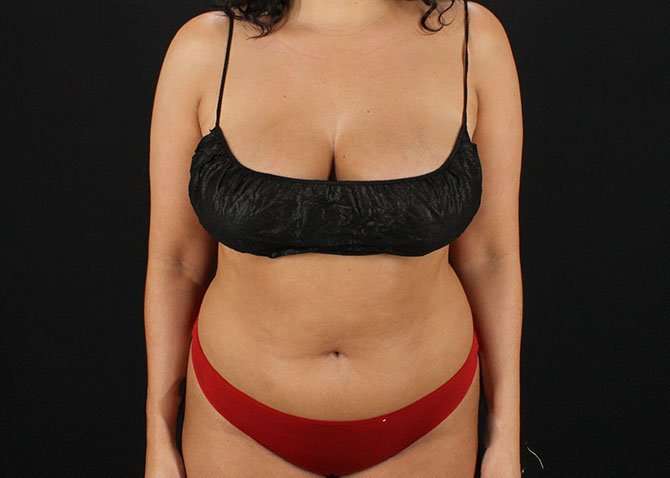 Liposuction Before & After Patient #1469