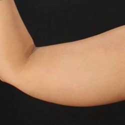 Liposuction Before & After Patient #1482