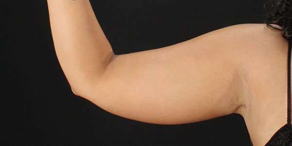 Liposuction Before & After Patient #1482