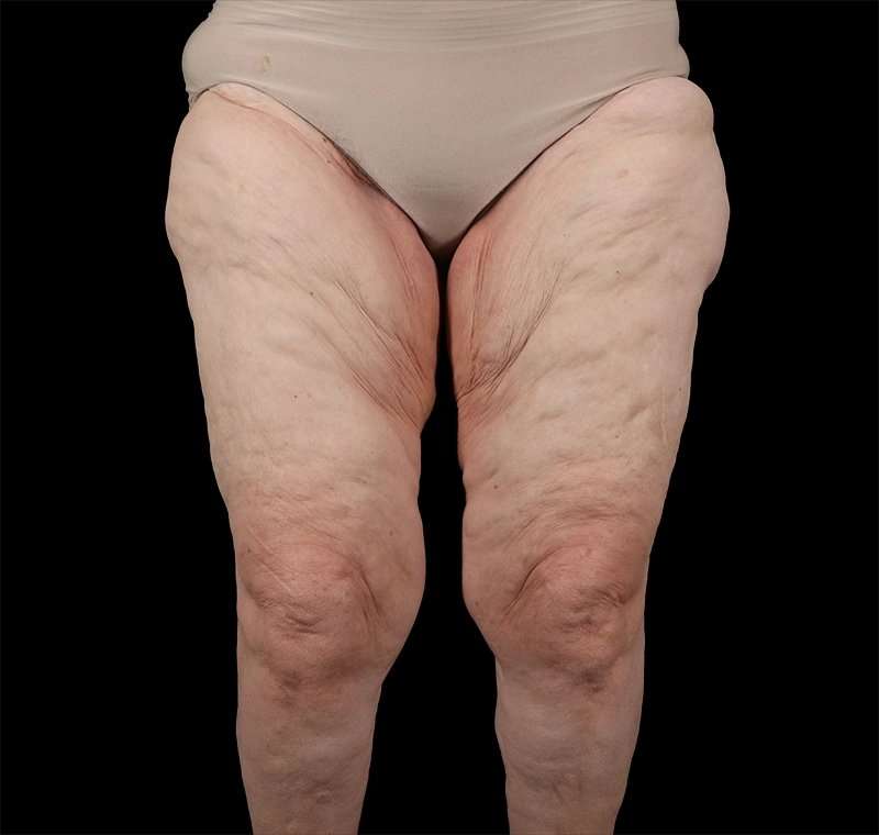 Liposuction Before & After Patient #1495
